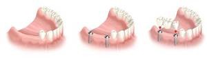 RTEmagicC_implantologie-wann-eignen-sich-implantate-bruecke-auf-implantate