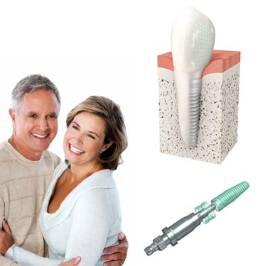 implantologie-was-sind-implantate